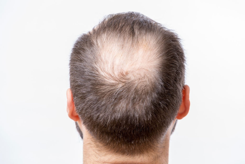¿Cómo prevenir alopecia androgenética?